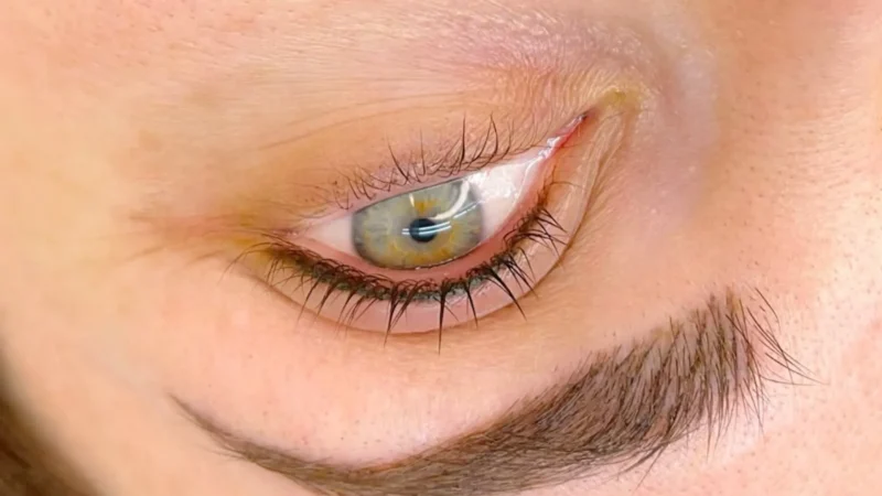 Eyeliner Tattoo Removal: Methods, Costs & Aftercare Guide